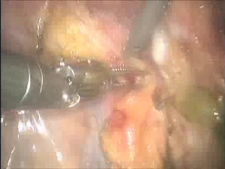 Dissection intersphinctérienne suivie d'une résection abdominopérinéale robotisée pour cancer rectal antérieur
