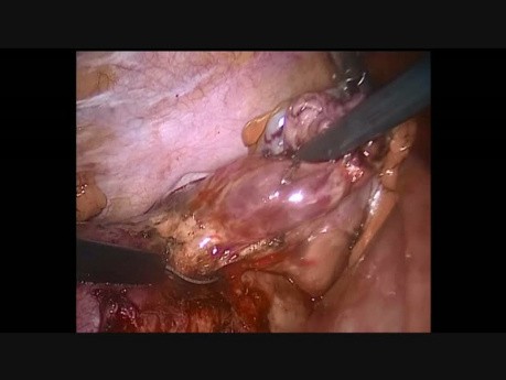 Laparoscopie pendant la grossesse