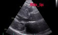 5. Cas d'échocardiographie - Qu'est-ce que vous voyez ?