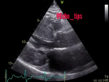 5. Cas d'échocardiographie - Qu'est-ce que vous voyez ?