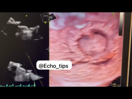 Échocardiographie Transœsophagienne (ETO) 3D Prospective de la Valve Mitrale et de l'Oreillette Gauche