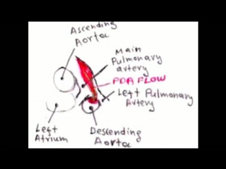 Persistance du canal artériel. Discussion sur l'ECG, l'échocardiographie et le traitement