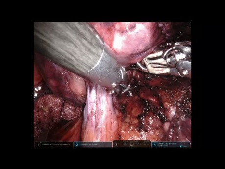 Chirurgie Pulmonaire - Segmentectomie Anatomique