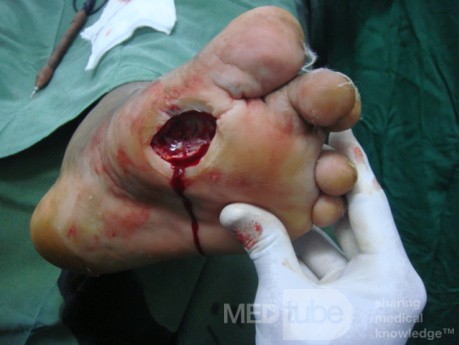 L'ulcère du pied diabétique avec l'ostéomyélite.
