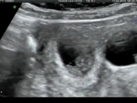 Réduction fœtale sélective transvaginale d'un jumeau dans une grossesse quadruple à un sac utérin