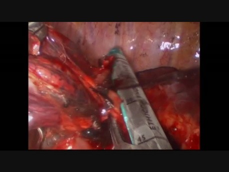 Résection anatomique du segment posterieur du lobe supérieur gauche S2 S4-5 - chirurgie thoracique vidéo-assistée (CTVA) à l'incision unique