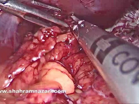 Chirurgie Laparoscopique de l'Achalasie Oesophagienne Associée à un Diverticule Oesophagien