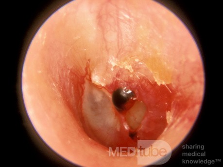 Perforation traumatique du tympan (3 jours après la survenue)