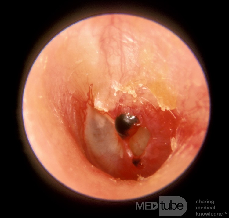 Perforation traumatique du tympan (3 jours après la survenue)