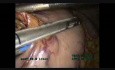 Oesophagectomie laparoscopique / thoracoscopique