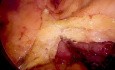Résection Sigmoïdienne Laparoscopique avec Résection de la Veine Cave en Patch pour Cancer du Sigmoïde T4