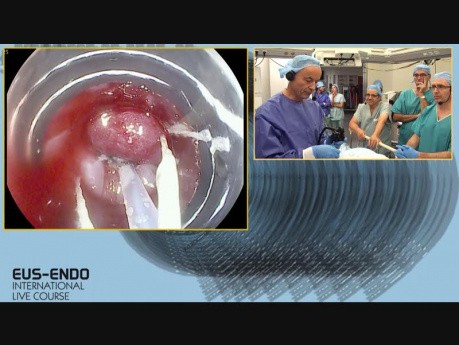 Dissection sous-muqueuse endoscopique ou résection muqueuse endoscopique par capuchon?
