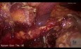 Colectomie droite laparoscopique en raison de diverticulite perforée