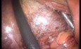 Cholécystectomie LESS avec Hystérectomie Supracervicale Concomitante Sans Anesthésie Générale