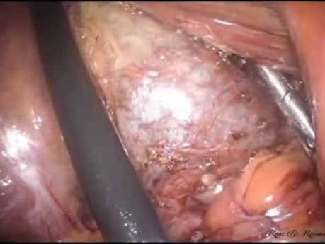 Cholécystectomie LESS avec Hystérectomie Supracervicale Concomitante Sans Anesthésie Générale