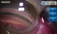 Implant de Microstent pour Glaucome dans le Quadrant Supérieur
