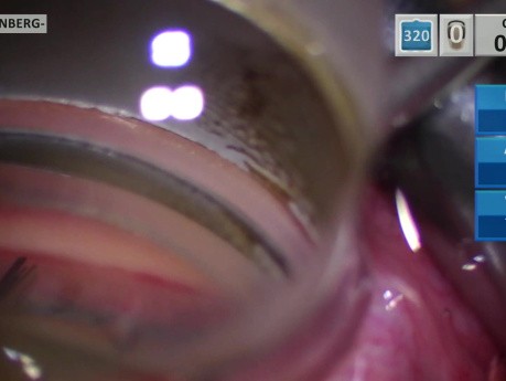 Implant de Microstent pour Glaucome dans le Quadrant Supérieur