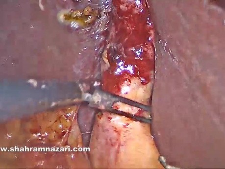 Dissection Artérielle dans un Cas de Vésicule Biliaire Fibrotique Chronique