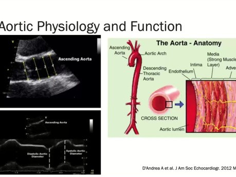 Échocardiographie des Maladies de l'Aorte- Ce Que Vous Voulez Savoir sur l'Aorte