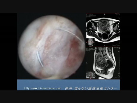 Résection hystéroscopique d'un énorme myome pesant 360g