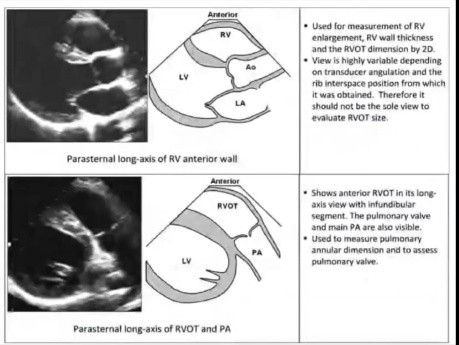 Quantification Echocardiographique des Cavités Droites