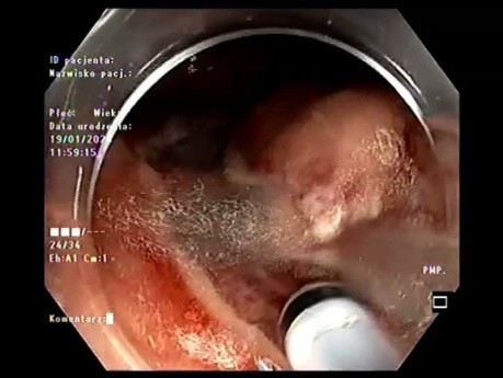 LST-G - Type Mixte - Dissection Sous-Muqueuse