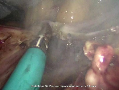 Hystérectomie vNOTES pour Fibrome Utérin