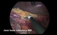 Intervention de Hartmann par voie laparoscopique