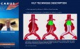 Technique KILT dans l'Anévrysme de l'Aorte Abdominale (à Cou Hostile) avec Endoprothèses de Support - Détails de la Technique et Compte-rendu