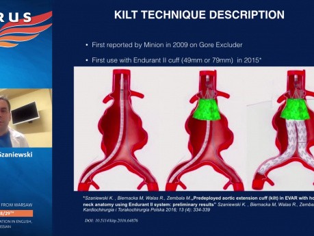 Technique KILT dans l'Anévrysme de l'Aorte Abdominale (à Cou Hostile) avec Endoprothèses de Support - Détails de la Technique et Compte-rendu