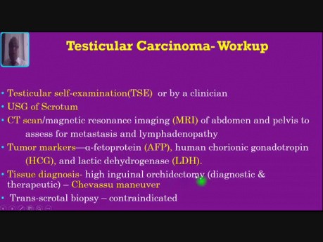 Tuméfaction scrotale - Cas n° 5 - Cancer du testicule