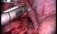 Cœlioscopie pour la maladie inflammatoire pelvienne (MIP)
