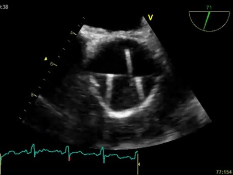 L'échocardiographie trans-oesophagienne