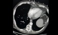 Nécrose circonscrite infectée du pancréas