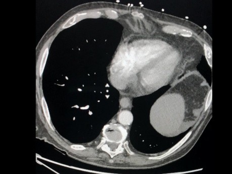 Nécrose circonscrite infectée du pancréas