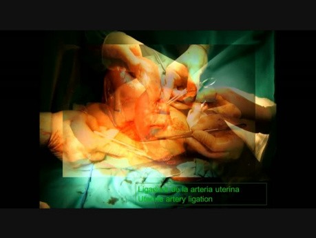 Ligature de l'artère utérine lors de césarienne