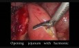 Pancréaticojéjunostomie par voie laparoscopique