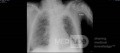 Radiographie thoracique d'un patient COVID-19 (3)