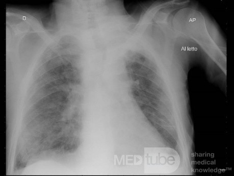 Radiographie thoracique d'un patient COVID-19 (3)