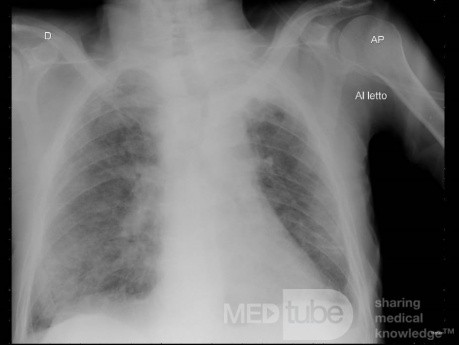Radiographie thoracique d'un patient COVID-19 (3)