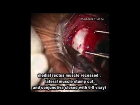 Prise en charge de la perte d'un muscle lors de l'opération du strabisme