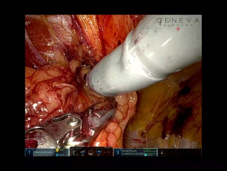 Hernie Inguinale Incisionnelle Féminine avec Antécédants d'Abord sus-pubien de 5 mm pour Douleur Inguinale Chronique, TAPP Robotisé