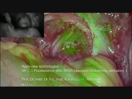 Anastomose rectale en utilisant le fluorophore ( vert d'indocyanine - ICG)