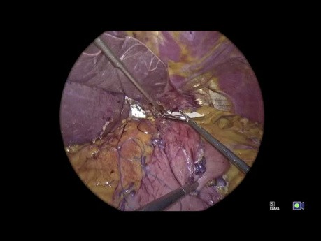 Application - Tutoriel Fundoplicature Géométrie