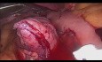 Mini-Bypass: Bypass Gastrique à Anastomose Unique