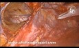 Réparation de Hernie Inguinale TAPP (Abord Cœlioscopique Trans-abdomino-prépéritonéal)