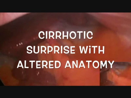 Cholécystectomie Laparoscopique avec Cirrhose de Découverte Fortuite