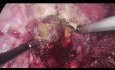 Résection hépatique thoracoscopique pour lésion située dans le segment 7