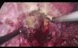 Résection hépatique thoracoscopique pour lésion située dans le segment 7