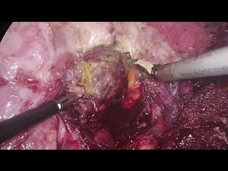 Résection hépatique thoracoscopique pour lésion située dans le segment 7